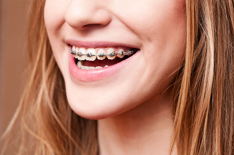 Orthodontics in Chesterfield