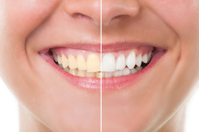 Teeth Whitening in Chesterfield